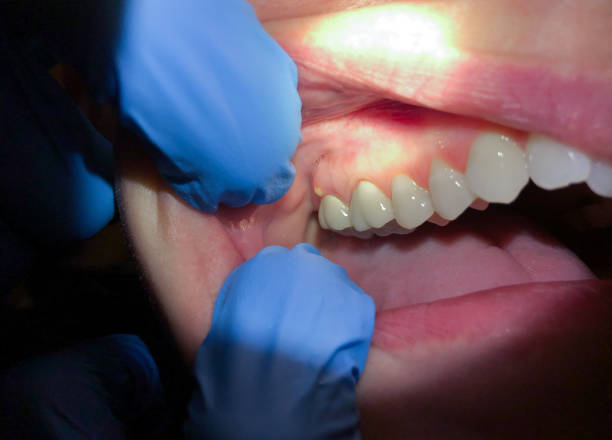 Best Emergency Wisdom Teeth Removal in Hickory, NC
